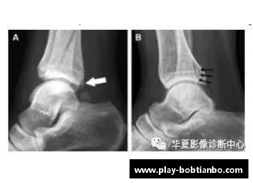 BOB天博球员踝骨骨折：原因、治疗及康复全解析 - 副本